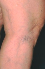 Leg Vein Sclerotherapy before 370428