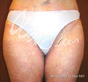 Inner Thigh Lift before 84026