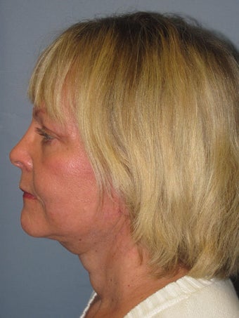 Neck Lift, Platysmaplasty 634748