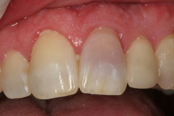 Internal Bleaching of Non-Vital Tooth before 379270