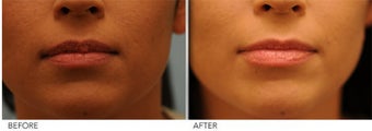 Upper Lip Reduction for Traumatic Lip Deformity before 391530