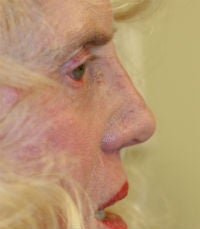 Revision rhinoplasty after 380426