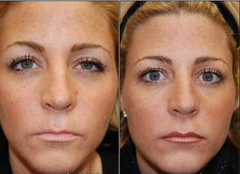 Liquid Face Lift with BOTOX Cosmetic and Silikon-1000 before 95072
