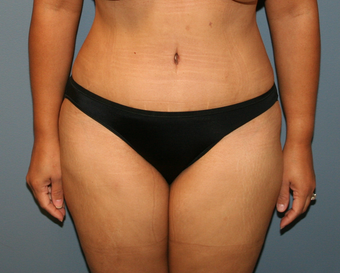tummy tuck after 527241
