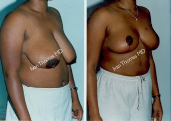 Breast Reduction before 243734