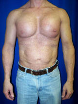 Pec Implants after 130083
