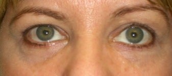 Restylane for eyes after 374299