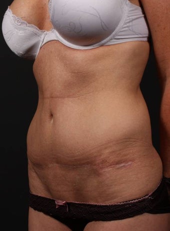 Full tummy tuck revision 356434