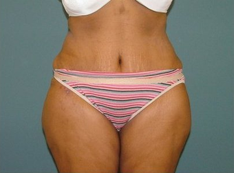 Tummy Tuck after 97008