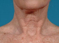 Laser resurfacing-Fraxel Re:store before 459021