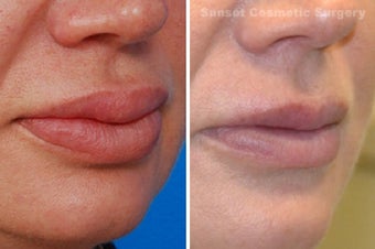 Lip Reduction and Repair after 485284