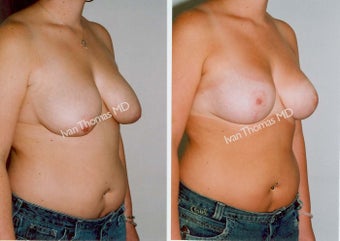 Mastopexy-Breast Lift before 243731