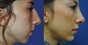 Rhinoplasty before 633433