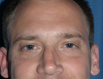Rhinoplasty before 118340