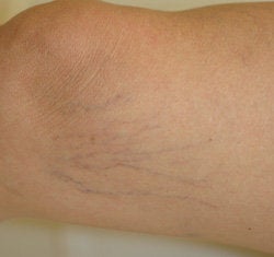 Leg vein removal with laser treatments before 106548