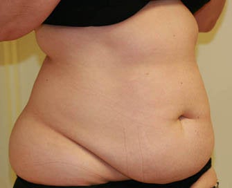 Abdominoplasty (Tummy Tuck) before 232368