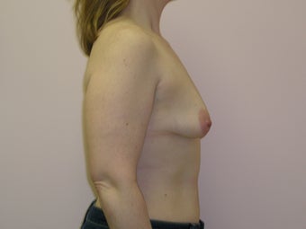 Breast Lift with Implants before 312862