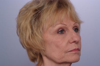 Laser Resurfacing before 253083