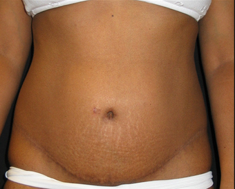 Abdominoplasty after 458934