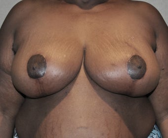 Breast Reduction after 287439
