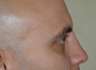 Non-Surgical Rhinoplasty after 118331