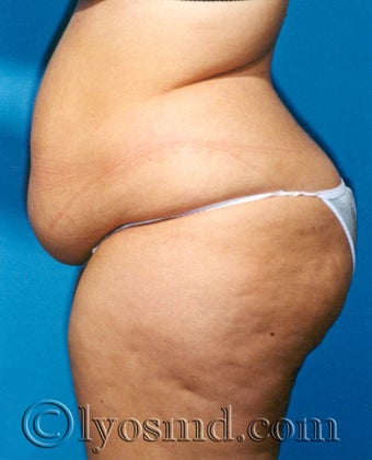 Liposuction before 233708