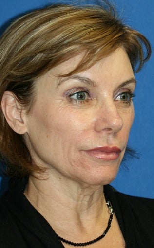 Facelift with Extended Necklift, Lateral Browlift, Fat Transfer, and Skin Pinch 540338