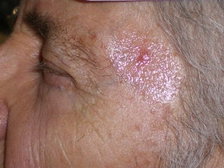 Basal Cell Carcinomas Excisions before 272099