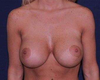 breast implant revision after 334113