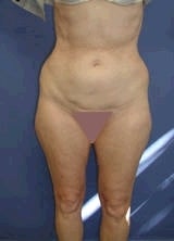 Liposuction before 139112