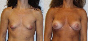 Breast Augmentation before 119322