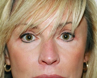 eyelid procedure before 380413