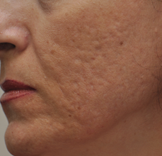 Acne Scarring before 426032