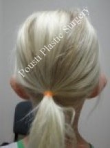 Ear Surgery (Otoplasty) 579109
