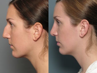 Nose Surgery 338481
