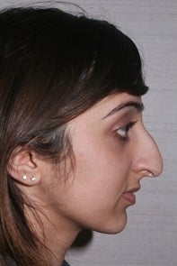 Asian Rhinoplasty 448659