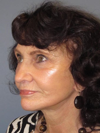 Obagi Blue Peel 635043