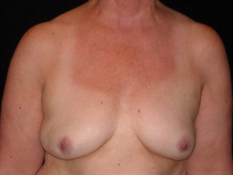 Breast implant removal after 566066