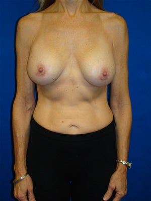 Breast Augmentation Surgery after 151616