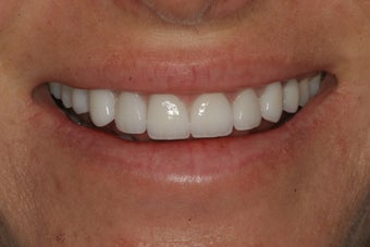 Porcelain Veneers after 213072