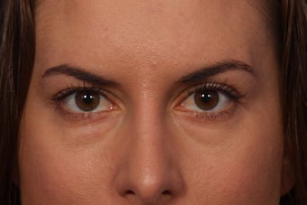 Restylane to Tear Troughs (under eyes) before 308348