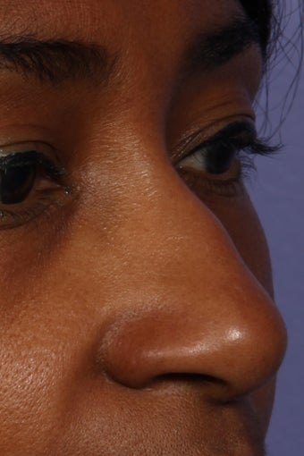 Restylane - Nose before 309233