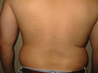 Liposuction 340028