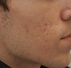Acne Scarring before 426027
