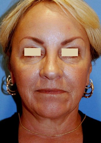 YoungLift ~ Fat Transfer (Full Face) before 139186