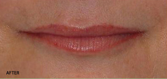 Juvederm - Upper and Lower Lip after 328108