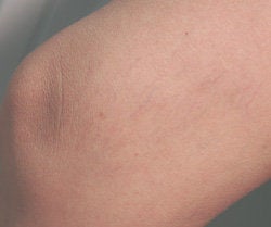 Leg vein removal with laser treatments after 106548