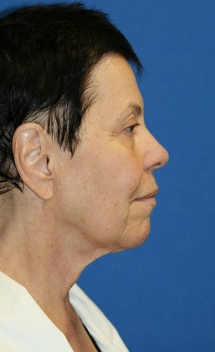 Facelift with Extended Necklift, Browlift, Fat Transfer, Upper Blepharoplasty, and Skin Pinch 625450