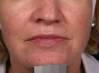 Vein treatment after 135901