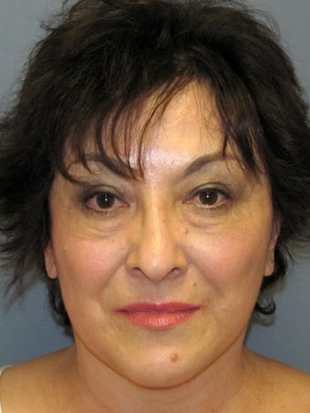 Neck Lift, Platysmaplasty after 634736